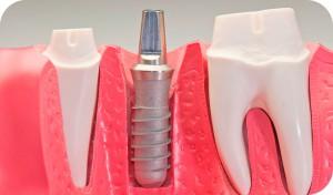 Implantes dentales
