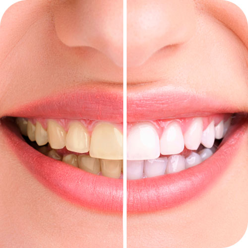 Blanqueamiento Dental