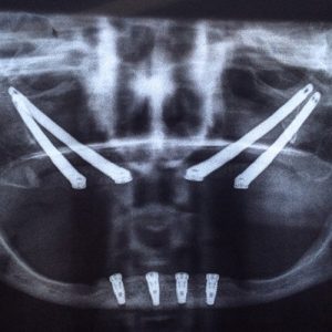 Implantes cigomáticos