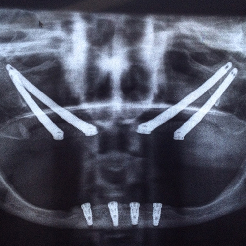 Implantes cigomáticos