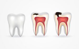 Endodoncia en caries profunda