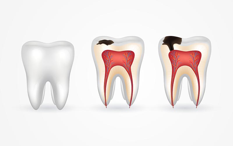 Endodoncia en caries profunda