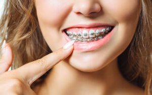 Ortodoncia tradicional con brackets en Murcia