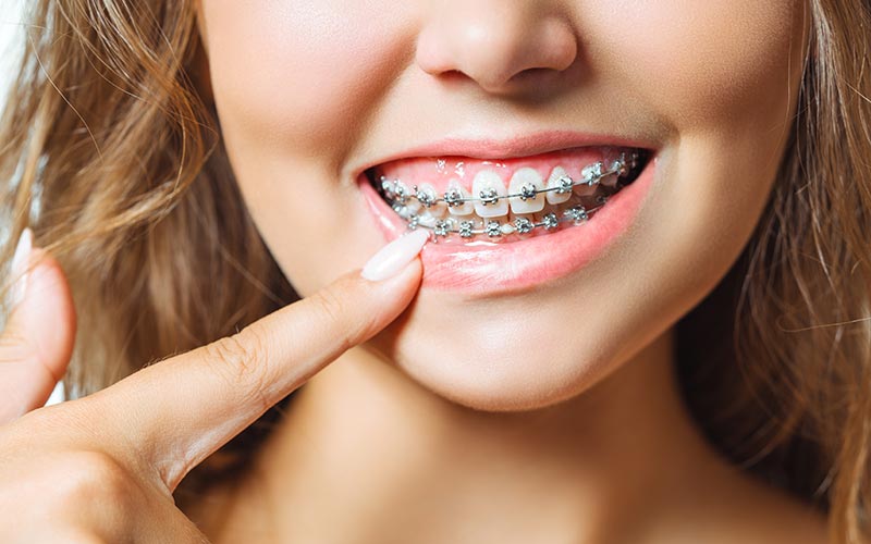 Ortodoncia tradicional con brackets en Murcia