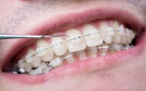 Ortodoncia con brackets cerámicos
