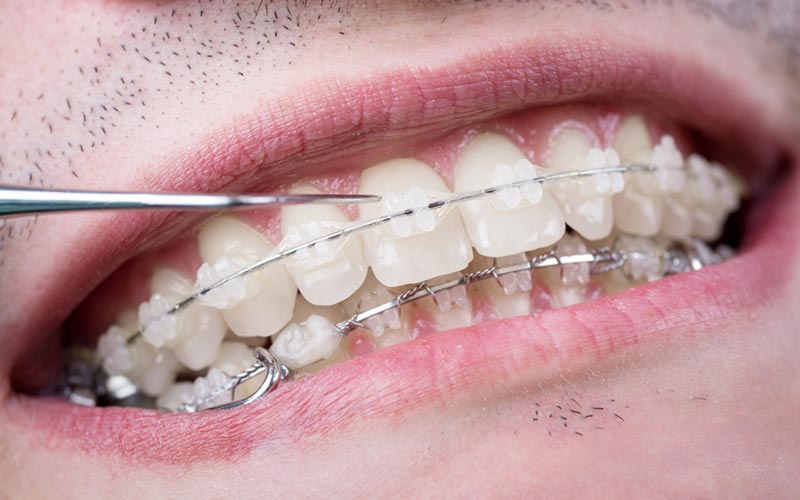 Ortodoncia con brackets cerámicos