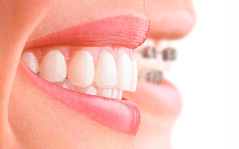 Ortodoncia invisible y tradicional con brackets en Murcia