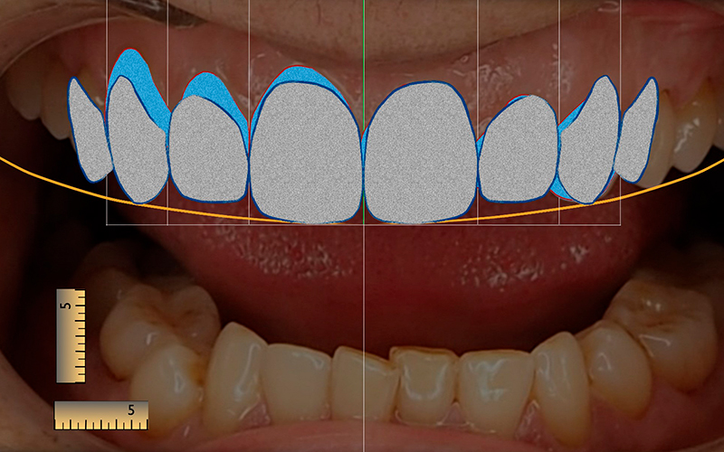 Diseño Digital de Sonrisa en Murcia - Software