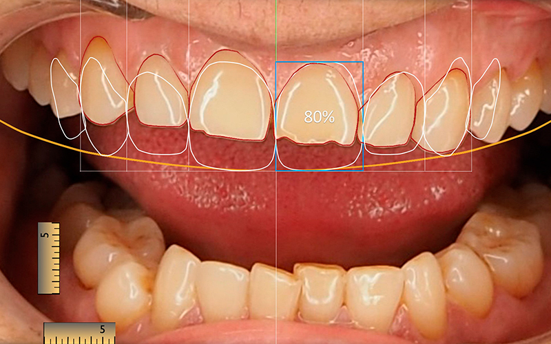 Diseño Digital de Sonrisa en Murcia - Trabajos en fotografías